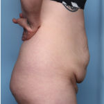 Body Lift Before & After Patient #34335